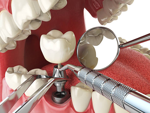 Best Emergency Tooth Extraction in Monte Alto, TX